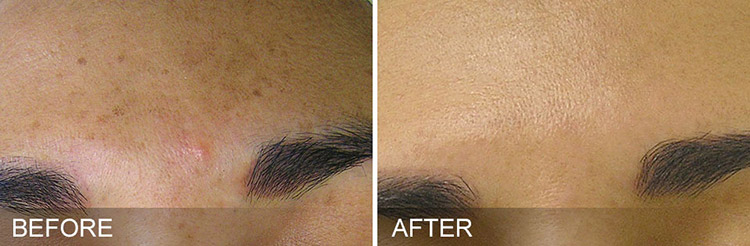 hydrafacial(ハイドラフェイシャル)